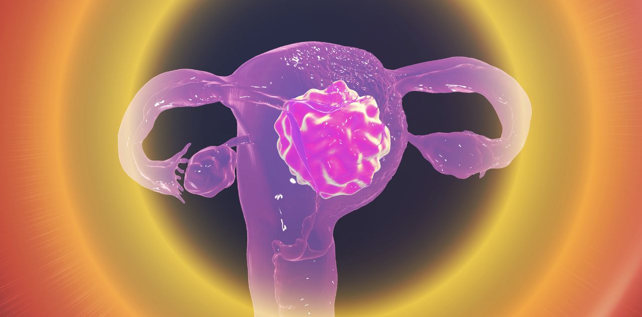 자궁경부암 CG 이미지