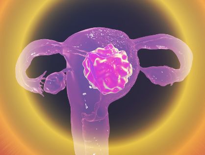 자궁경부암 CG 이미지